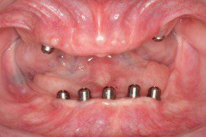 Implant Retained dentures Before