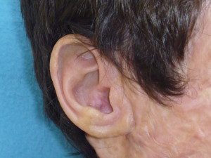 Maxillofacial Auricular Prosthesis After