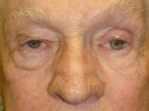 Maxillofacial Ocular Prosthesis After