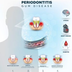 Gum Disease - Piedmont Dental Associates